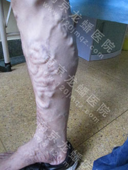 男科溃疡用手术吗？